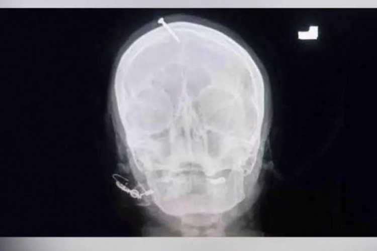 nail in waman head x ray 750x450 - Pour « garantir » la naissance d’un petit garçon, une femme enceinte se fait planter un clou dans la tête