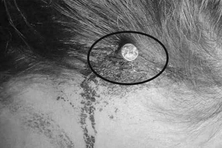 nail in woman head 750x450 - Incroyable : Une femme enceinte se fait planter un clou dans la tête (Photos)