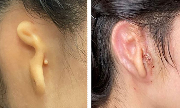 3D-ear-transplant