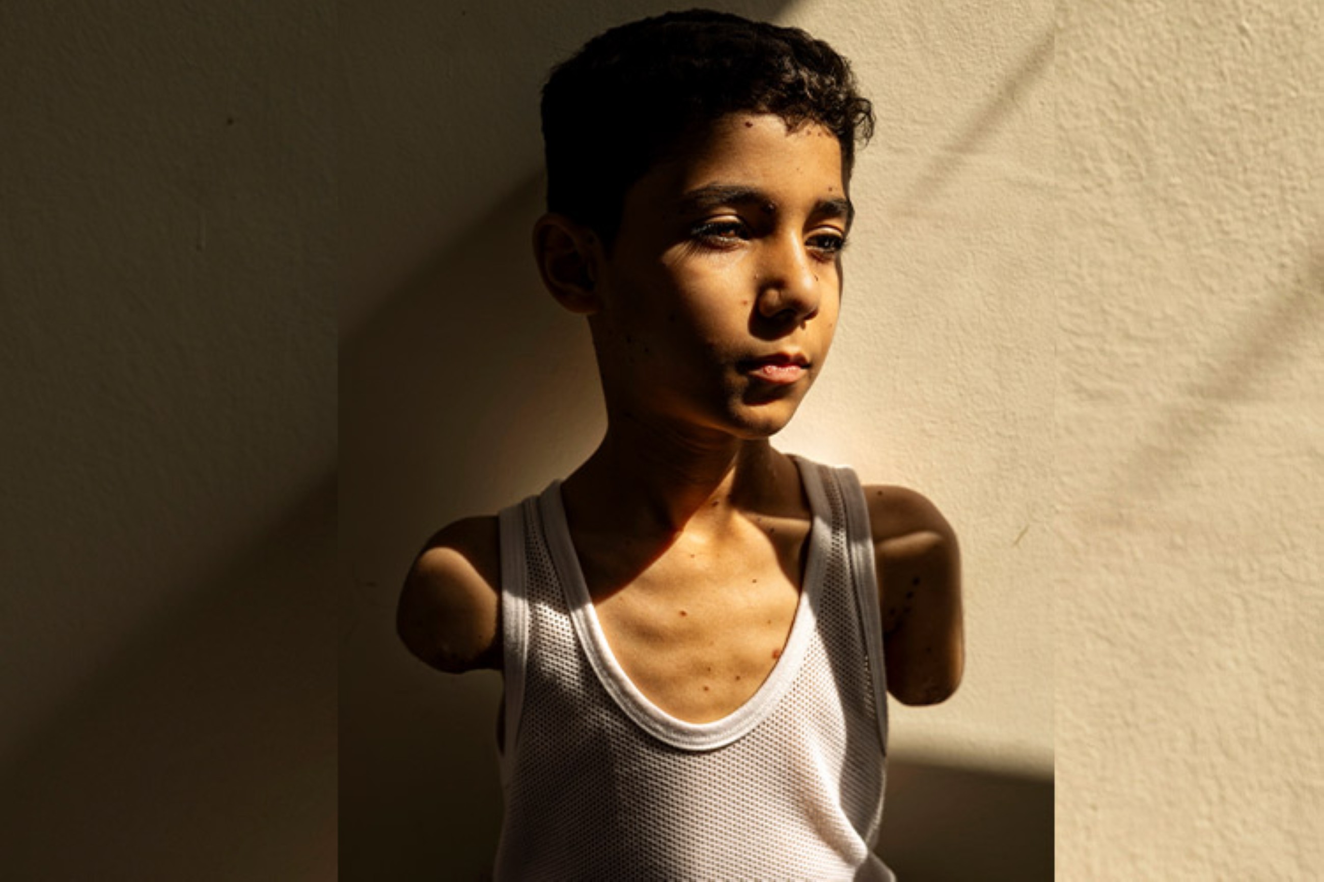 Picture of Palestinian boy who lost both arms in Gaza attack is World Press Photo of 2025