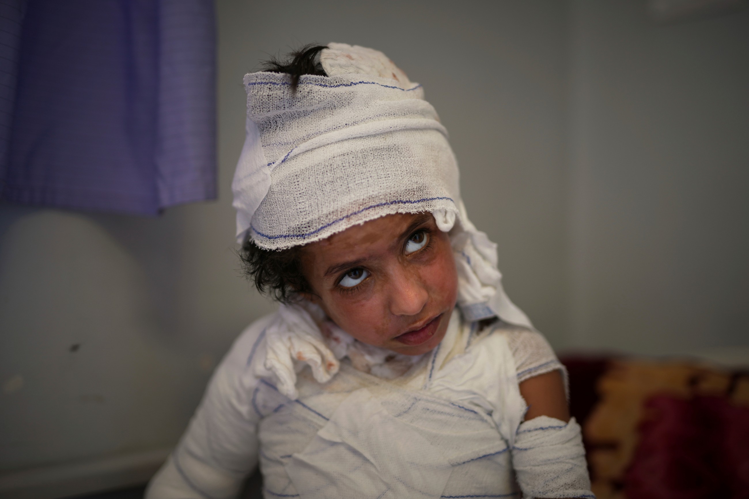 Burn patients face excruciating recovery as medicines dwindle under Israeli blockade of Gaza