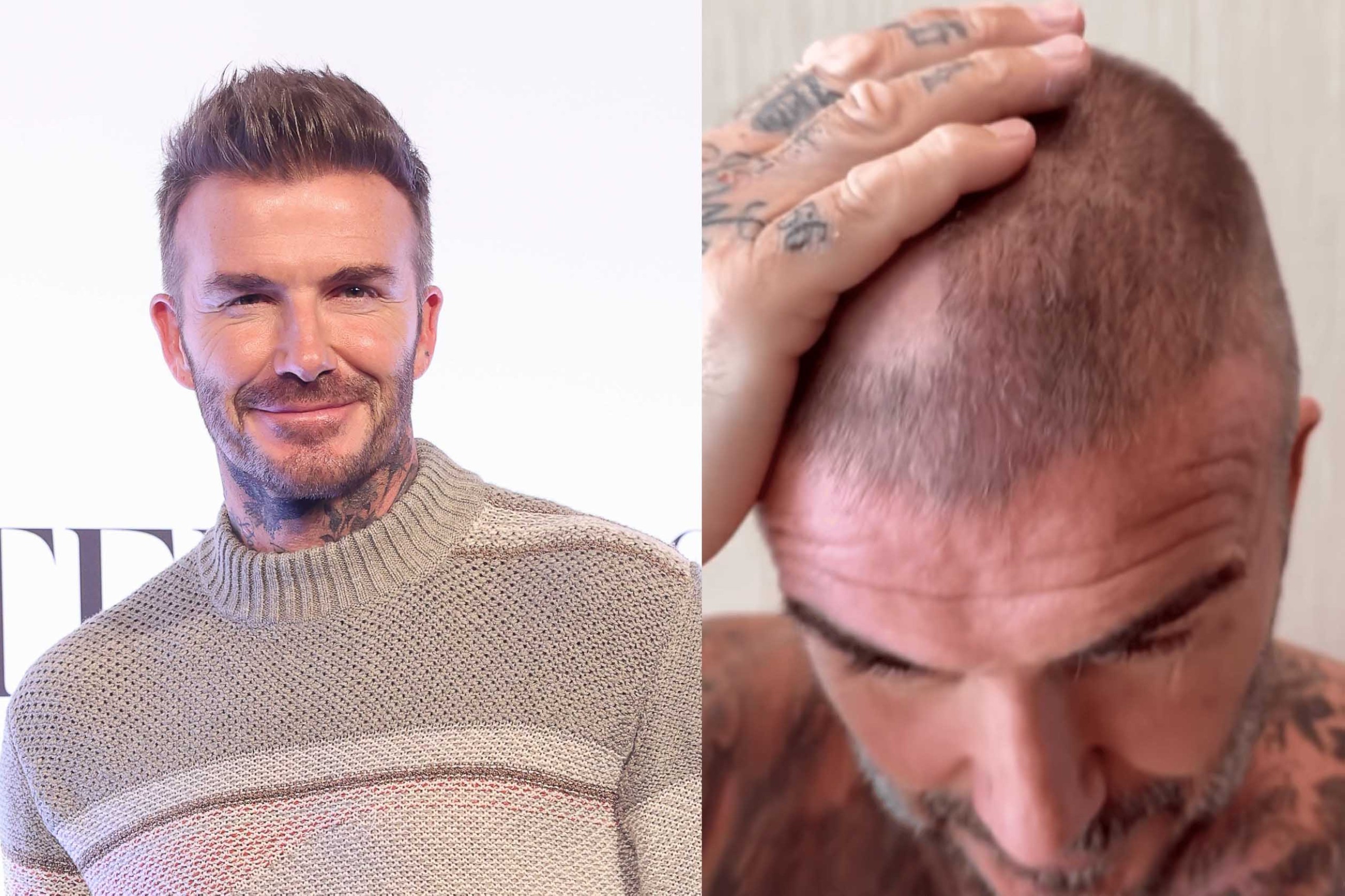 David Beckham left with bald patch after ‘terrible’ hair accident
