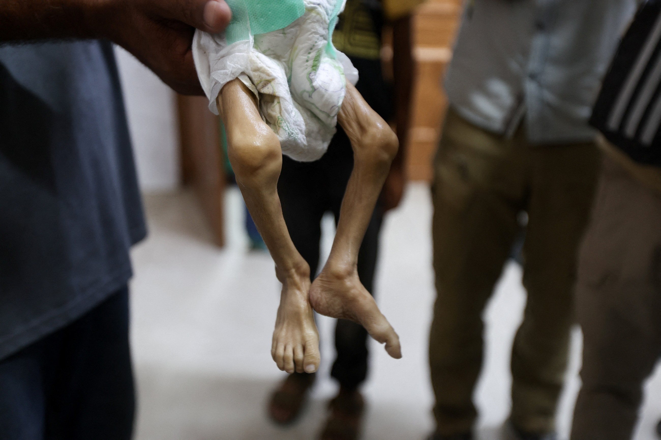 Malnutrition reaching 'alarming levels' in Gaza, warns WHO