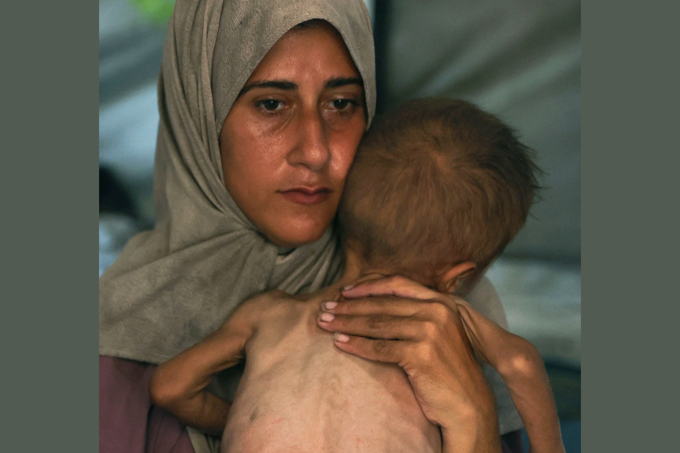 Gaza malnutrition