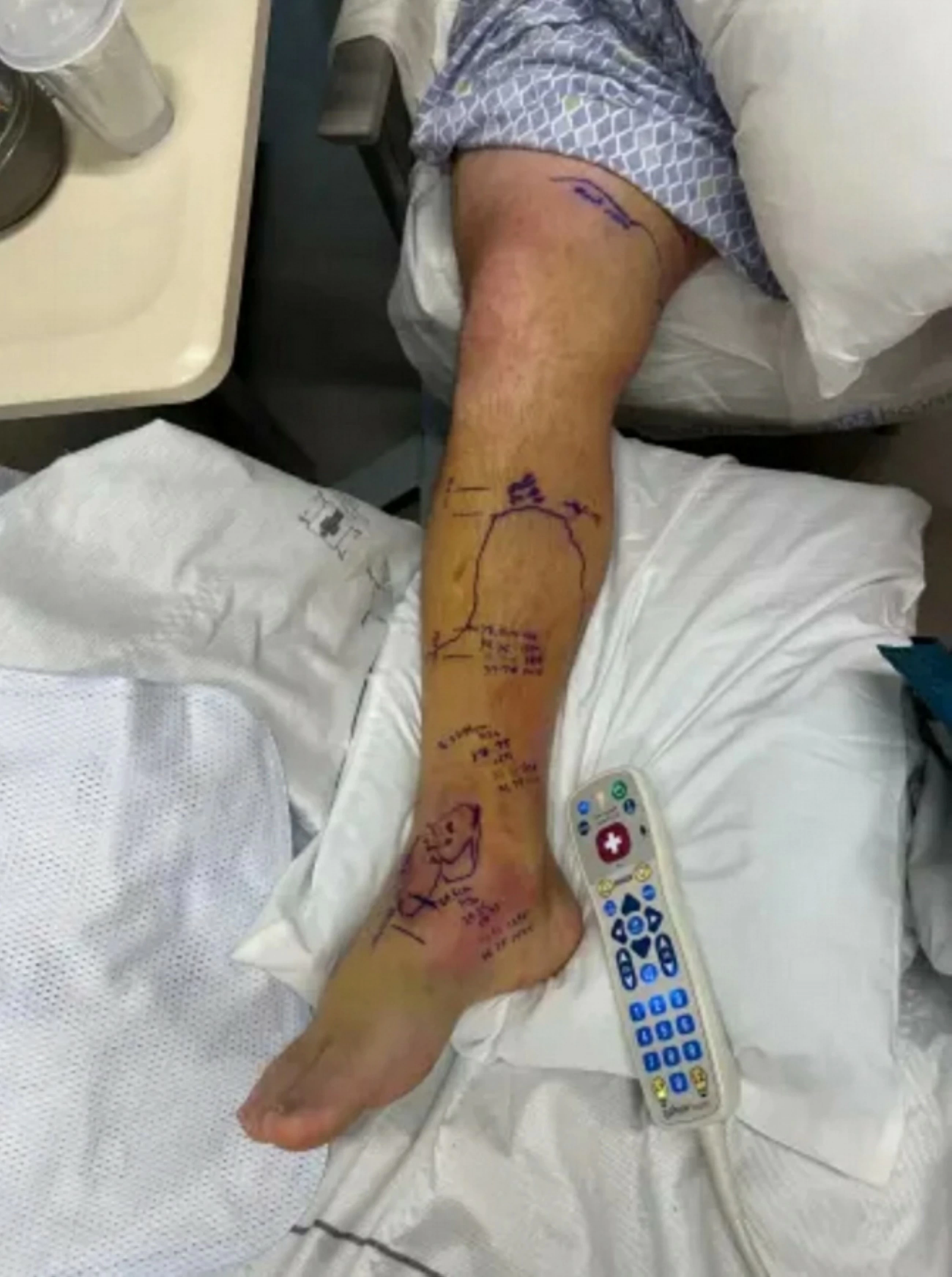 US father survives double rattlesnake bite, faces $1.3m medical bill